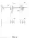 Fig. 17 - Responsive electrical stimulation for movement disorders