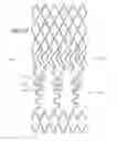Fig. 17 - Ostium support for treating vascular bifurcations