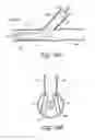 Fig. 25 - Ostium support for treating vascular bifurcations