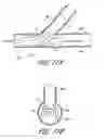 Fig. 26 - Ostium support for treating vascular bifurcations