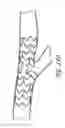 Fig. 30 - Ostium support for treating vascular bifurcations