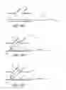 Fig. 31 - Ostium support for treating vascular bifurcations