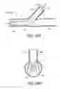 Fig. 25 - Ostium support for treating vascular bifurcations