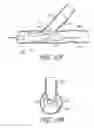 Fig. 26 - Ostium support for treating vascular bifurcations