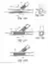 Fig. 28 - Ostium support for treating vascular bifurcations