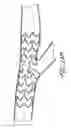 Fig. 30 - Ostium support for treating vascular bifurcations