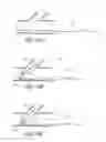 Fig. 31 - Ostium support for treating vascular bifurcations