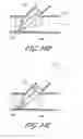 Fig. 32 - Ostium support for treating vascular bifurcations