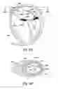 Fig. 14 - TRANSLUMENAL APPARATUS, SYSTEM, AND METHOD