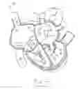 Fig. 04 - APPARATUS AND METHOD FOR REPLACING A DISEASED CARDIAC VALVE