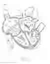 Fig. 29 - APPARATUS AND METHOD FOR REPLACING A DISEASED CARDIAC VALVE