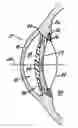 Fig. 01 - Ophthalmic sizing devices and methods