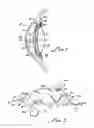 Fig. 02 - Ophthalmic sizing devices and methods