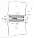 Fig. 01 - Anatomic spinal implant having anatomic bearing surfaces