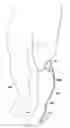 Fig. 01 - Replaceable fairing for prosthetic limb or brace