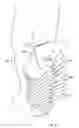 Fig. 09 - Replaceable fairing for prosthetic limb or brace