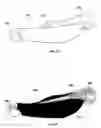 Fig. 16 - Replaceable fairing for prosthetic limb or brace