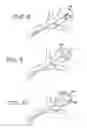 Fig. 04 - Vascular embolization with an expansible implant