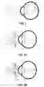 Fig. 02 - REAR APERTURE SIGHT FOR RIFLE