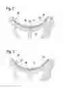 Fig. 03 - Apparatus for fastening a handle on a power tool