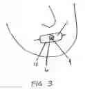 Fig. 03 - Methods of treating a disorder by inhibiting expiration