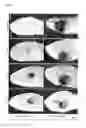 Fig. 04 - USE OF AN OZONE/OXYGEN MIXTURE AS PRIMARY ANTICANCER THERAPY THROUGH INTRAPERITONEAL INSUFFLATION