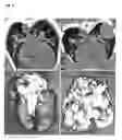 Fig. 05 - USE OF AN OZONE/OXYGEN MIXTURE AS PRIMARY ANTICANCER THERAPY THROUGH INTRAPERITONEAL INSUFFLATION