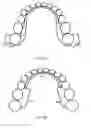 Fig. 06 - INTRA-ORAL BRACKETS FOR TRANSMITTING VIBRATIONS