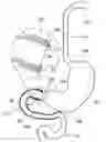 Fig. 01 - External anchoring configurations for modular gastrointestinal prostheses