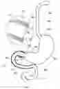 Fig. 02 - External anchoring configurations for modular gastrointestinal prostheses