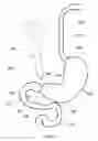 Fig. 10 - External anchoring configurations for modular gastrointestinal prostheses