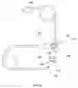 Fig. 12 - External anchoring configurations for modular gastrointestinal prostheses