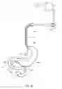Fig. 13 - External anchoring configurations for modular gastrointestinal prostheses