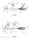 Fig. 14 - External anchoring configurations for modular gastrointestinal prostheses