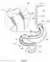 Fig. 22 - External anchoring configurations for modular gastrointestinal prostheses