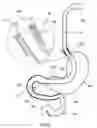 Fig. 23 - External anchoring configurations for modular gastrointestinal prostheses