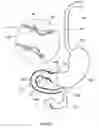 Fig. 24 - External anchoring configurations for modular gastrointestinal prostheses