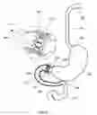 Fig. 28 - External anchoring configurations for modular gastrointestinal prostheses