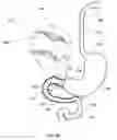 Fig. 29 - External anchoring configurations for modular gastrointestinal prostheses