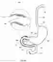 Fig. 31 - External anchoring configurations for modular gastrointestinal prostheses