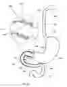 Fig. 32 - External anchoring configurations for modular gastrointestinal prostheses