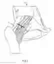Fig. 03 - INTERNAL TISSUE RETRACTION DEVICE, METHOD OF USE, AND SYSTEM