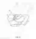 Fig. 10 - Subcutaneous access device and related methods