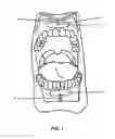 Fig. 02 - Gingival wafer