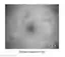 Fig. 01 - EFFECT OF RADIOFREQUENCY FIELDS ON CELL GROWTH AND METHODS FOR LAPAROSCOPIC TREATMENT