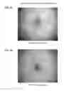 Fig. 05 - EFFECT OF RADIOFREQUENCY FIELDS ON CELL GROWTH AND METHODS FOR LAPAROSCOPIC TREATMENT