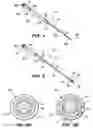 Fig. 04 - Ablation probe with echogenic insulative sheath