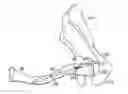 Fig. 01 - BONE FIXATION USING AN INTRAMEDULLARY PIN