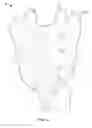 Fig. 04 - Transiliac-transsacral method of performing lumbar spinal interventions