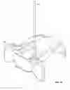 Fig. 10 - Transiliac-transsacral method of performing lumbar spinal interventions